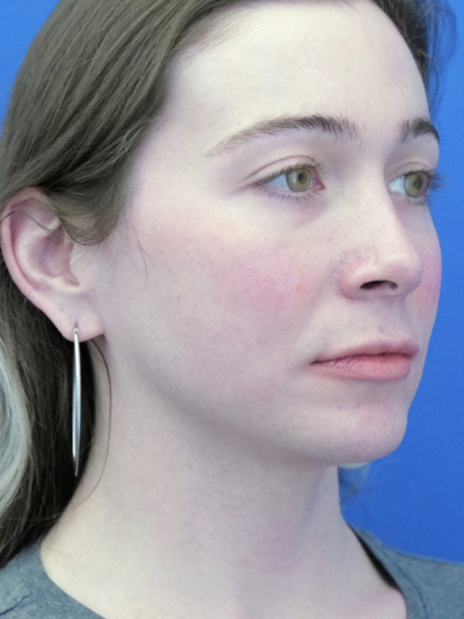 Soften Nasal Contour — After
