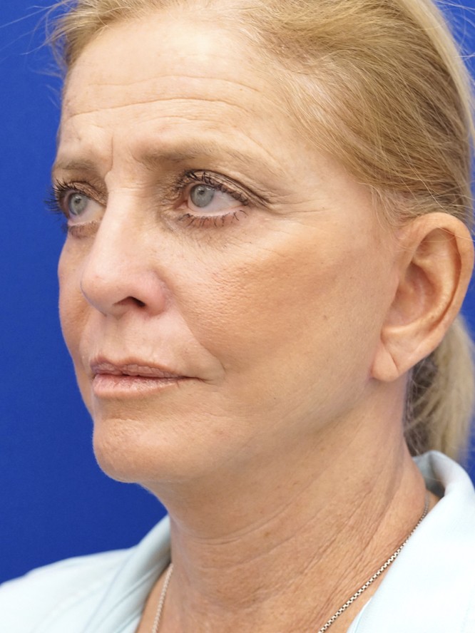 Deep Plane Lower Facelift — After