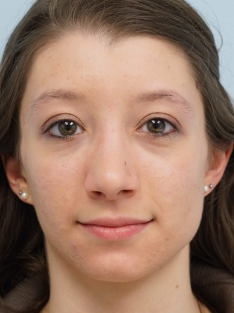 Prominent Nose Closed Rhinoplasty* — After