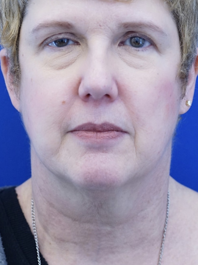 Facelift Platysmaplasty with Subplatysmal Lipectomy — Before