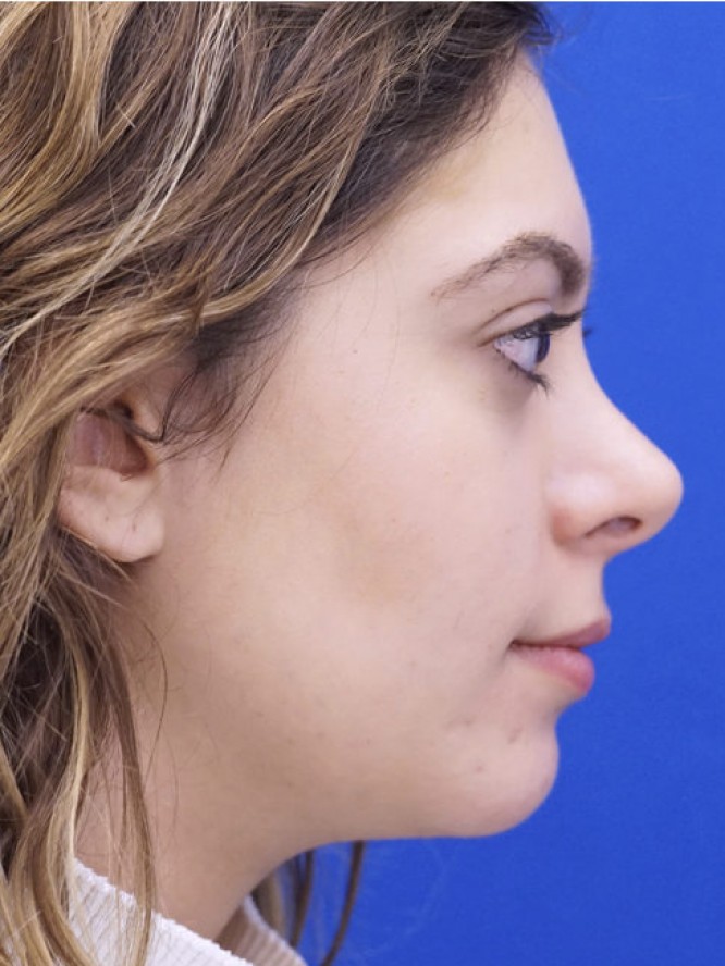 Hump Reduction and Chin Projection — After