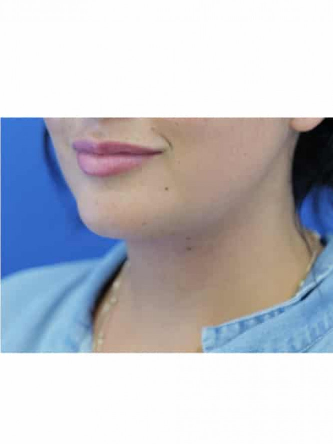 Platysmaplasty Without Skin Resection — After