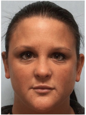 Juvederm to Upper & Lower Lips* — After