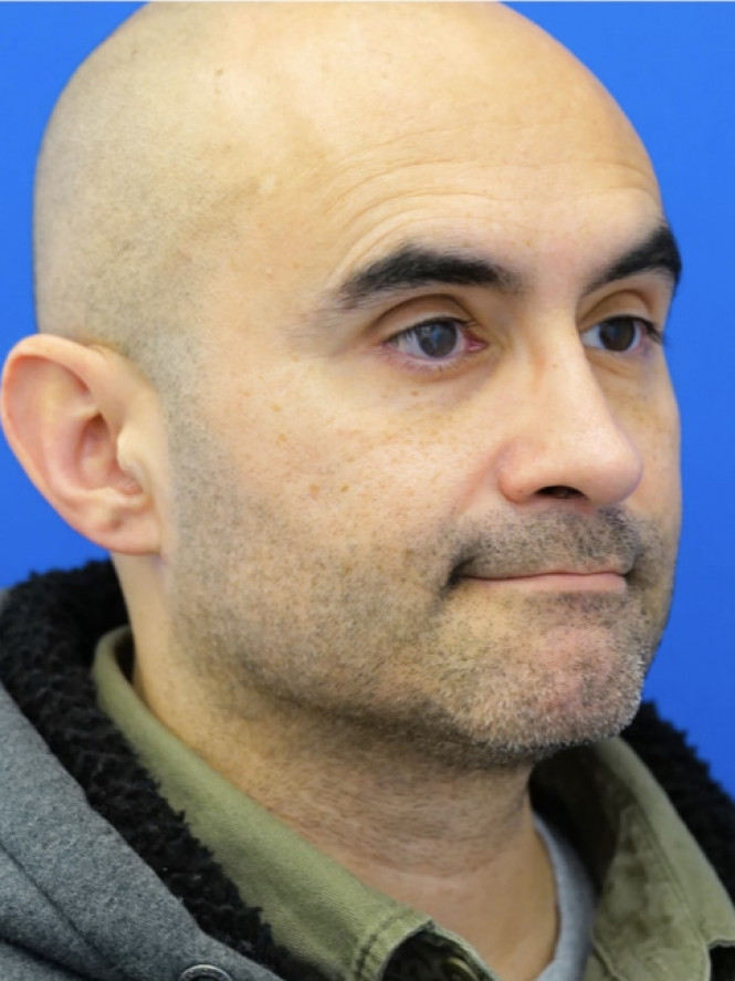 Tension Tip Ptosis — After