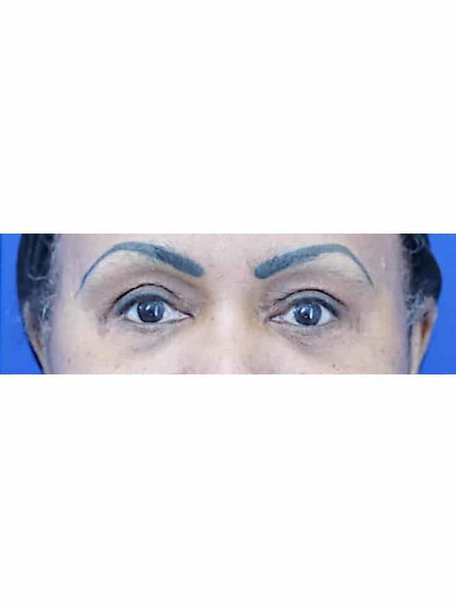 Quad Blepharoplasty Skin Only with Fat Grafting — After