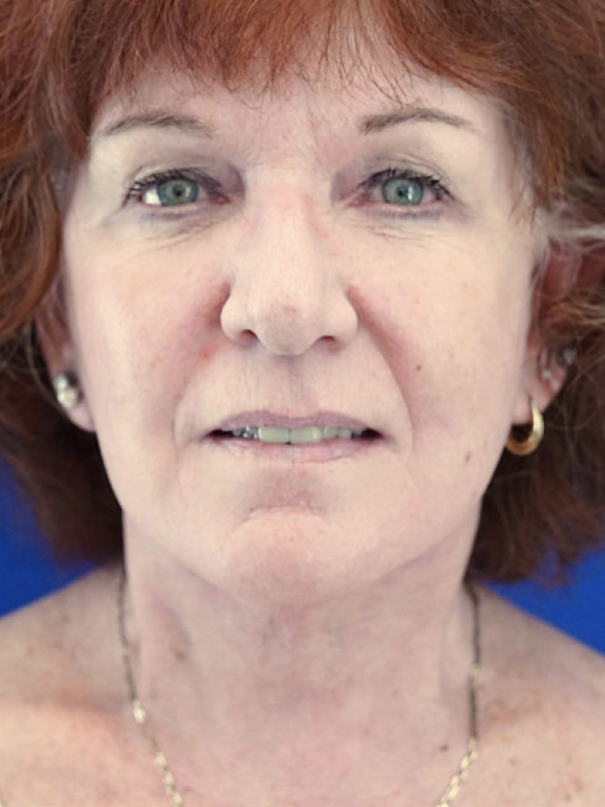 Neck Loose Skin — After