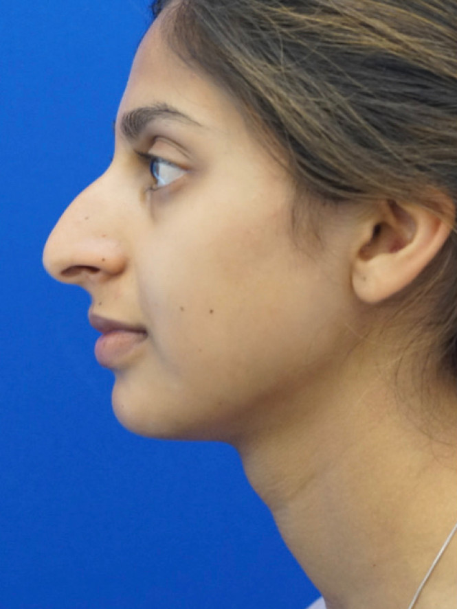 Natural Result — Before