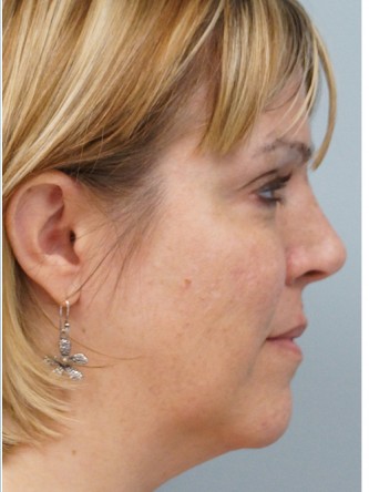Cheek Augmentation using Voluma* — After