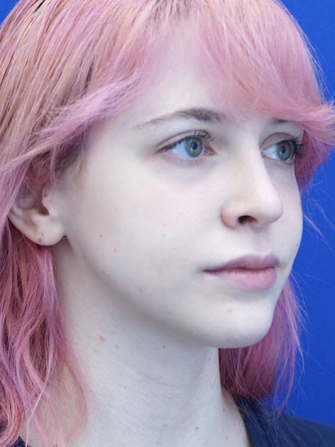 Long Droopy Tip — After