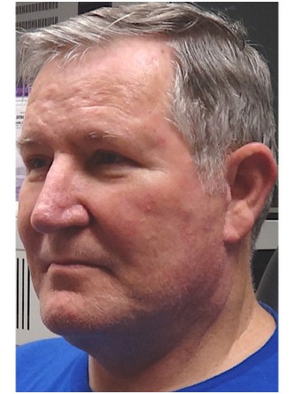 Aging Eyelid Rejuvenation, Facelift, Necklift 1* — After