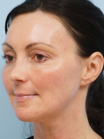 Fractional CO2 Laser Skin Resurfacing2* — After