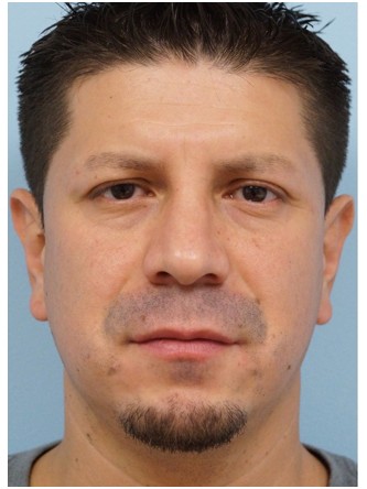 Protruding Ears – Upper Third* — Before