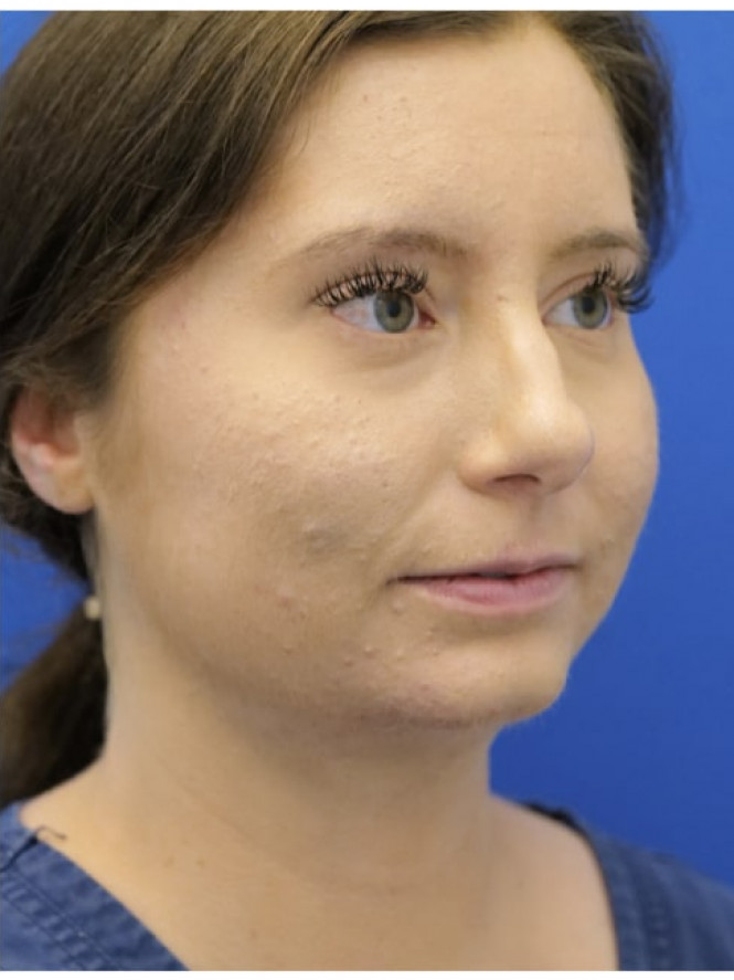 Chin Augmentation and Liposuction — After