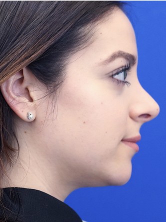 Finesse Nasal Aesthetics* — After