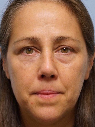 Nasal Septal Perforation2* — After