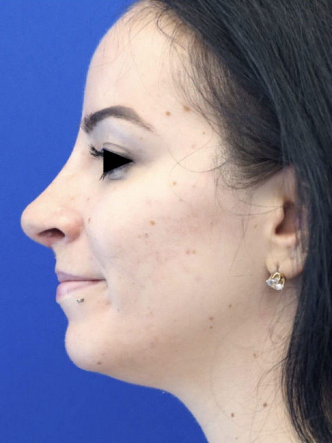 Nasal Tip Refinement — After