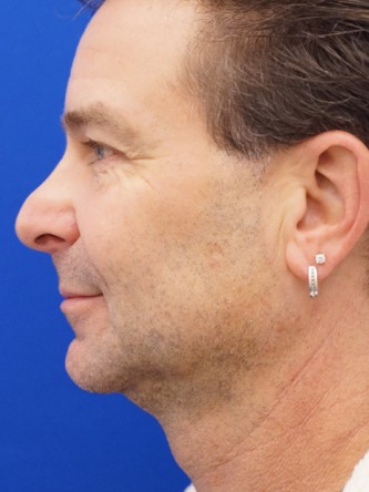 Nasal Tip Droop* — Before
