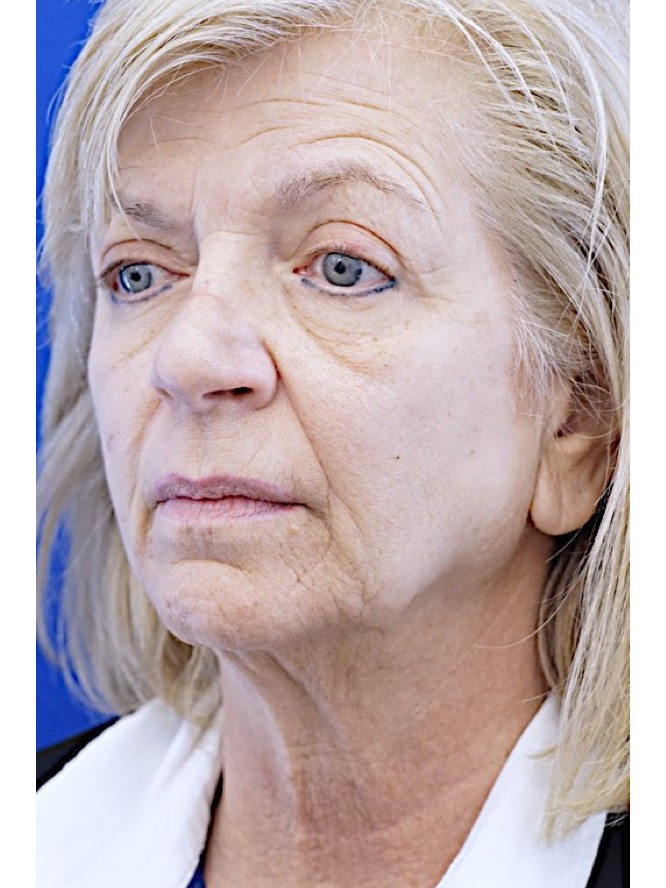Jowls and Loose Neck Skin — Before