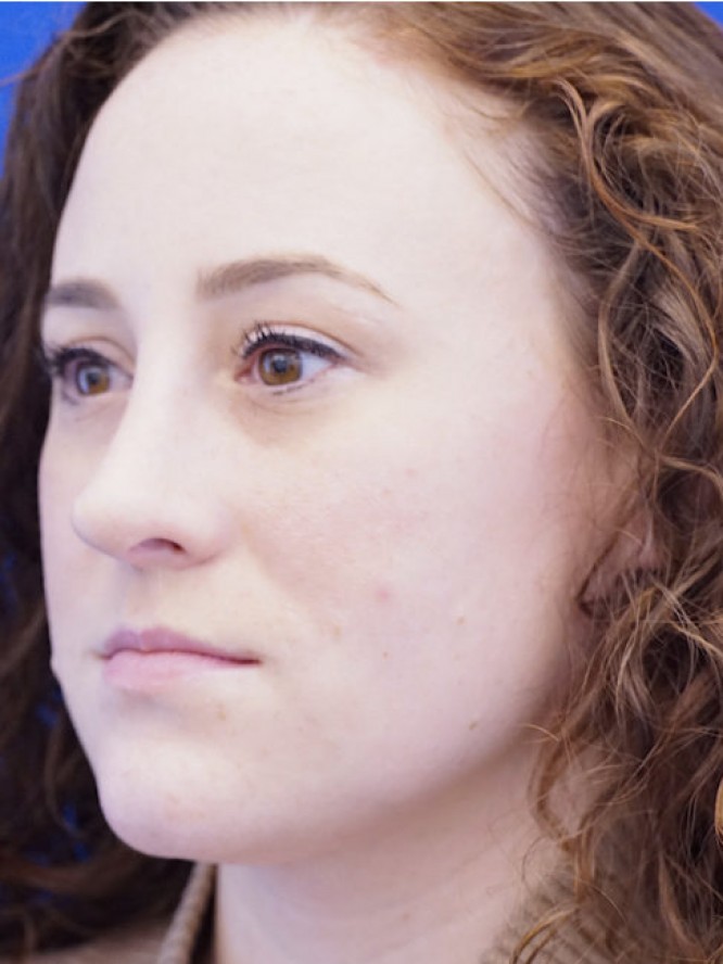Finesse Nasal Contour — After