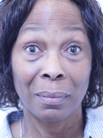 Tear Trough Under Eye Enhancement — Before