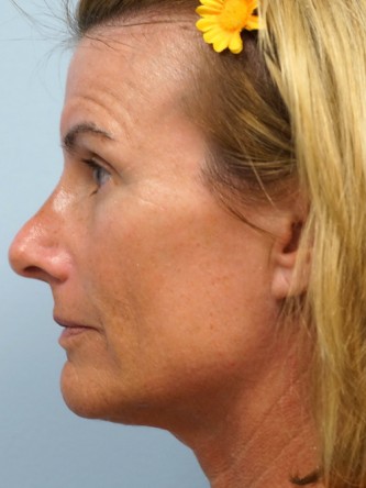Voluma to Malar Cheek* — Before