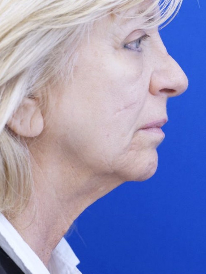 Jowls and Loose Neck Skin — Before