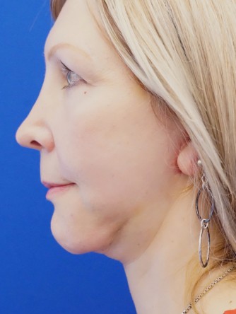 Revision Chin Implant, Mini Lift* — After