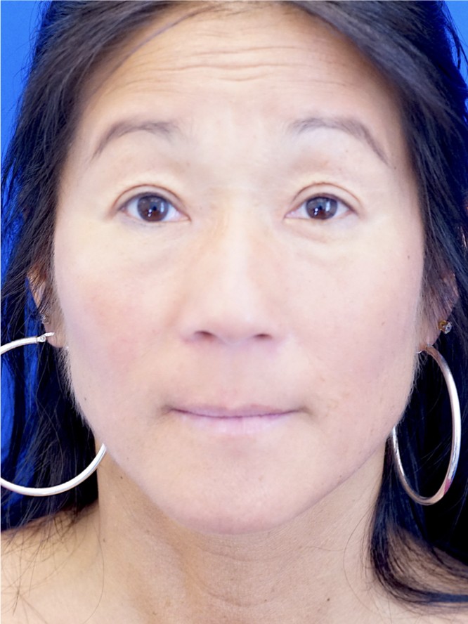 Asian Crease Creation — After