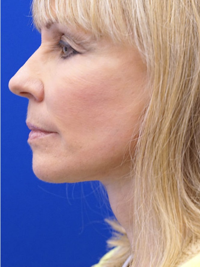 Neck Rejuvenation — After