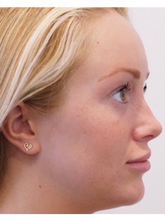 Restylane Silk to Upper & Lower Lips* — After