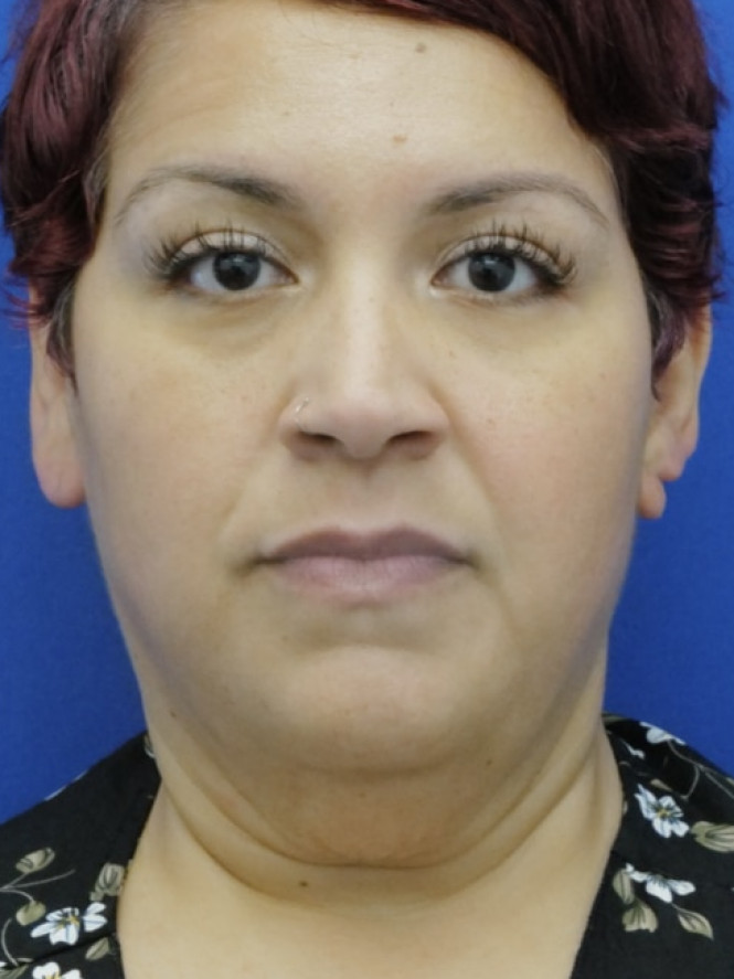 Necklift and Lower Facelift — Before