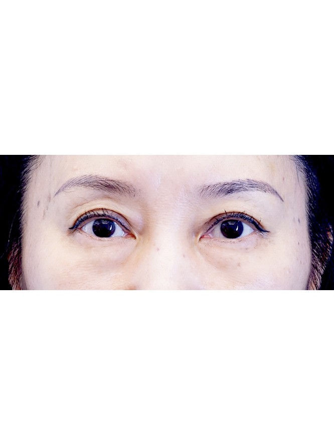 Lower Blepharoplasty with Fat Repositioning — Before
