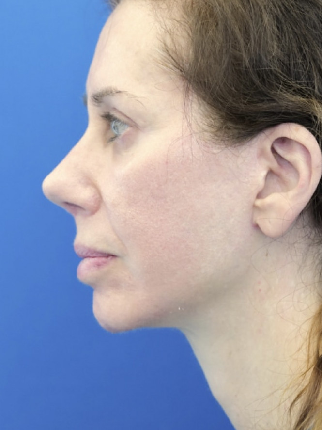 Natural Result — After