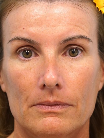 Voluma to Malar Cheek* — Before