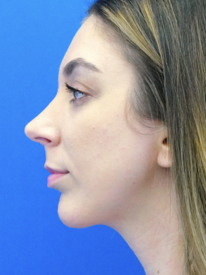 Facial Profile Balance — After