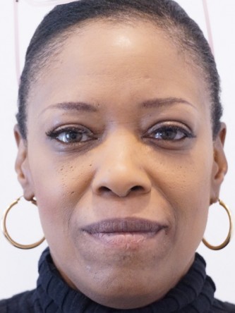 Restylane Silk Reduces Lip Wrinkles* — Before
