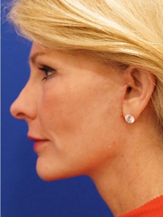 Mini Facelift* — After