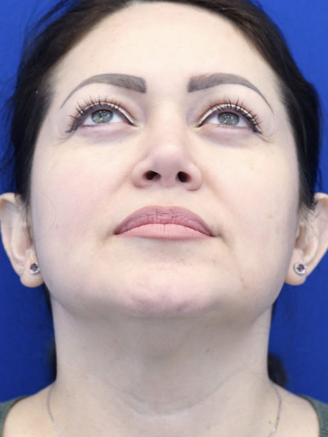 Nasal Tip Asymmetry — After