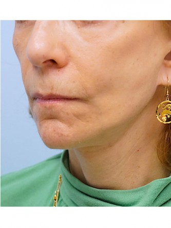 Full Face and Necklift, Upper and Lower Eyelid, Browlift* — After