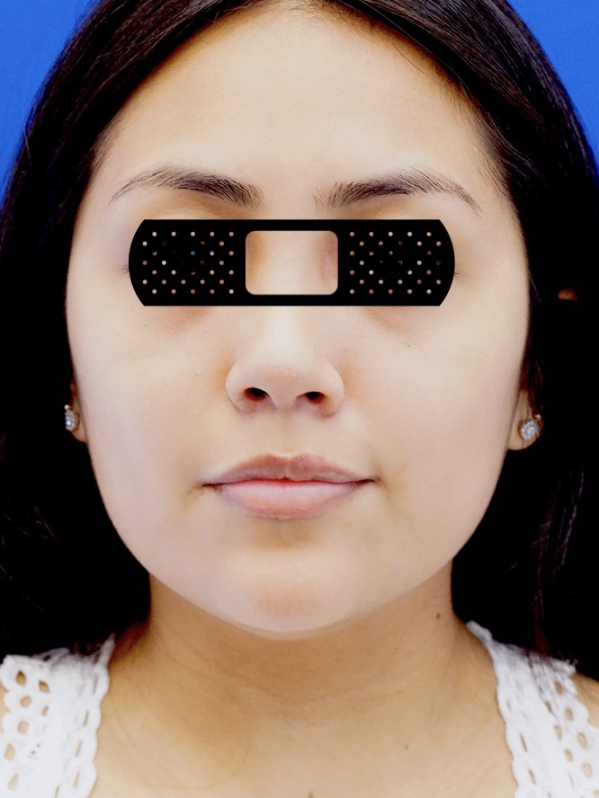Buccal Fat Removal — After