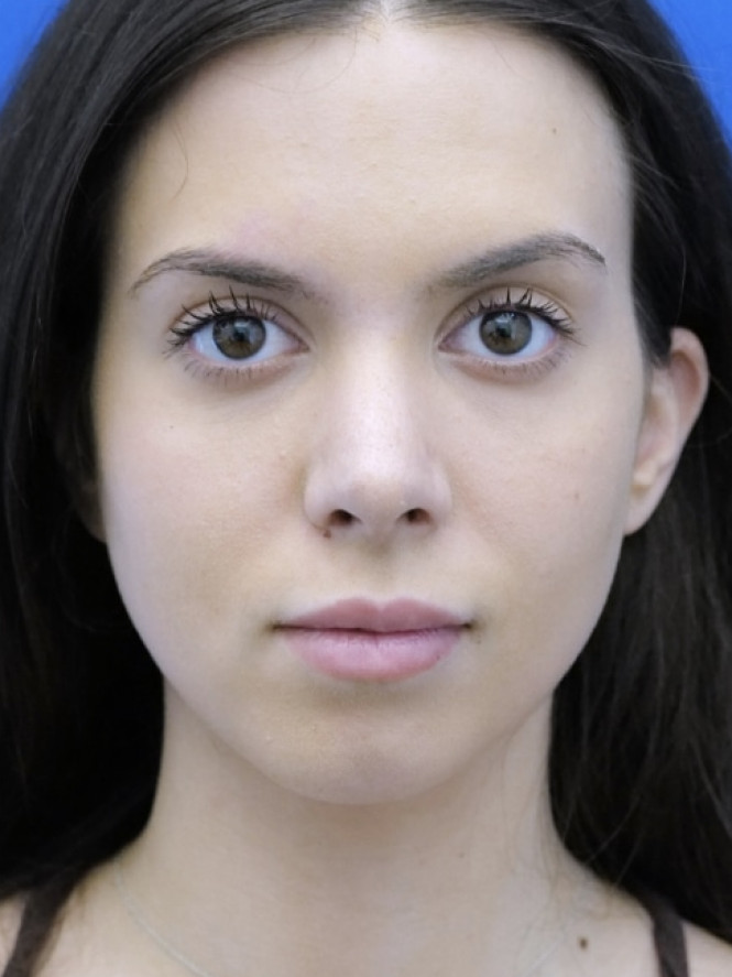 Preservation Rhinoplasty2 — After