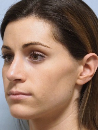 Mild Dorsal Hump & Droopy Tip1* — After