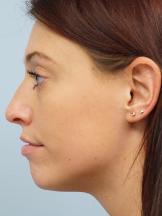 Cupid’s Bow Enhancement by Juvederm* — Before
