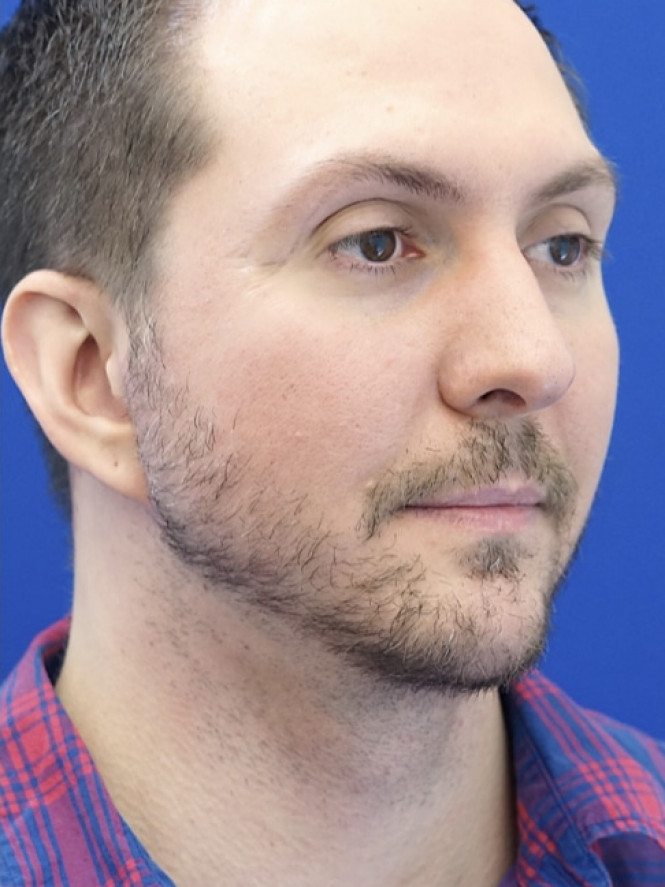 Lower Facial Contouring — After