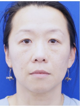 Unilateral Ptosis Repair* — After