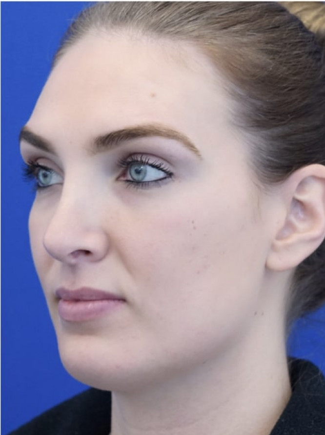 Tension Nose — After
