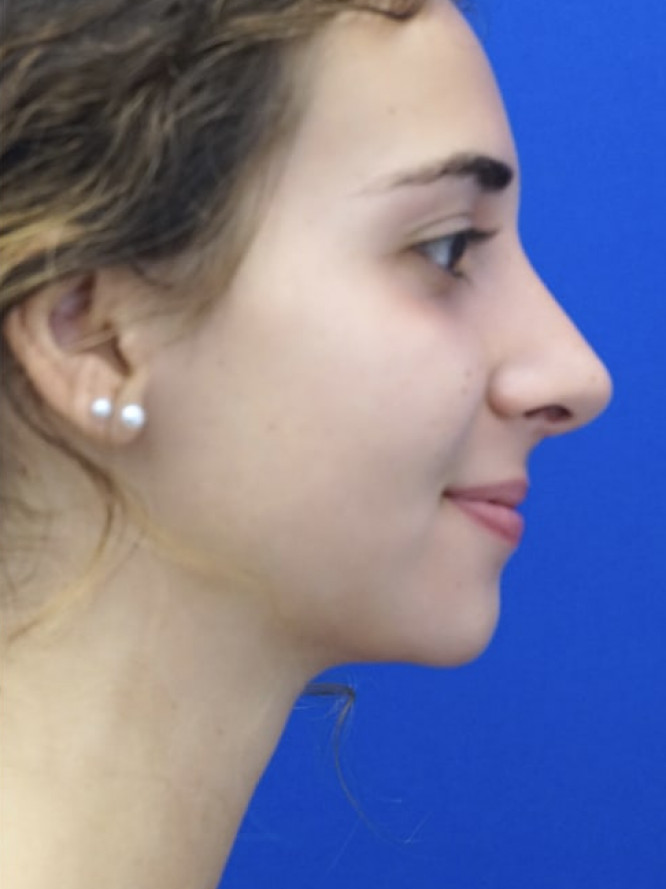 Classic Tension Nose — After