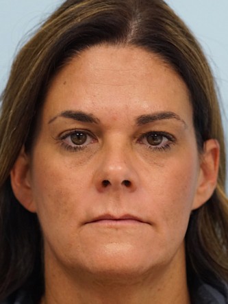Glabellar Botox and Filler* — After