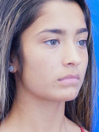 Voluptuous Lip Enhancement* — Before