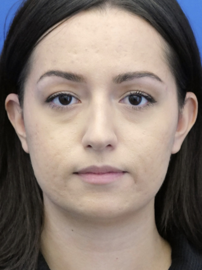 Dorsal Hump Removal — After